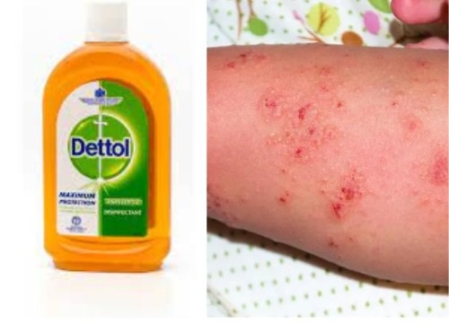 Can Dettol Kill Scabies