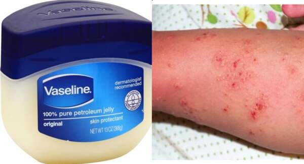 Does Vaseline Kill Scabies